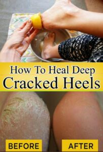 How To Get Rid Of Cracked Heels?